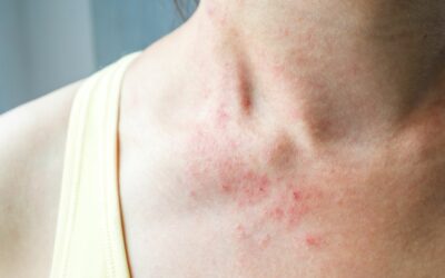 An Effective Treatment for Eczema