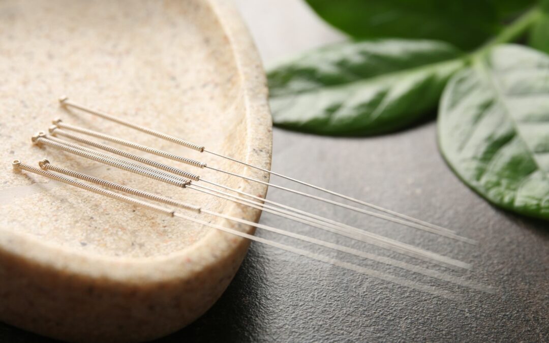 Exploring the Differences Between Dry Needling and Acupuncture