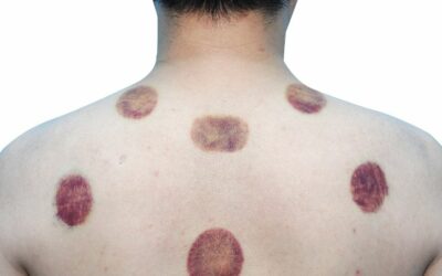 Understanding the Causes and Treatment of Dark Cupping Marks