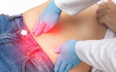 Hernia Acupuncture Treatment: A Promising Alternative Approach