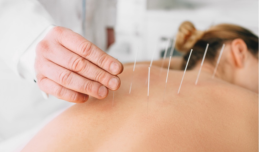 The Effectiveness of Acupuncture for Shingles: A Comprehensive Guide