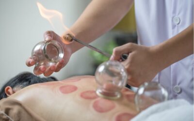 Does Cupping Work for Back Pain?