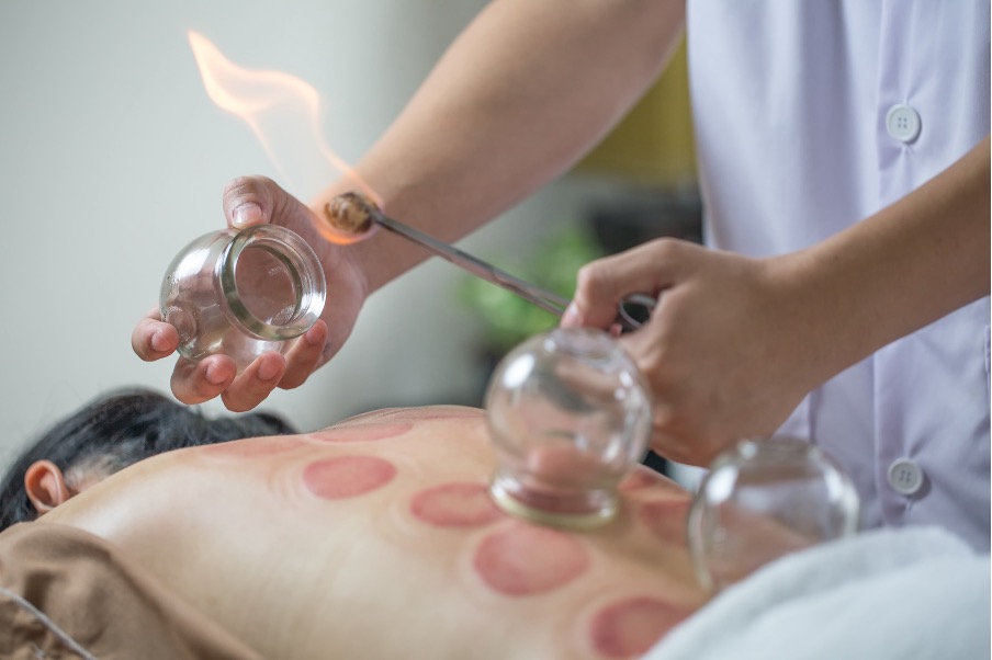 Does Cupping Work for Back Pain?