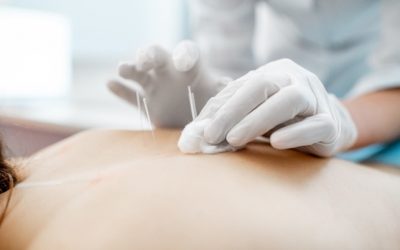 5 Amazing Benefits of Acupuncture
