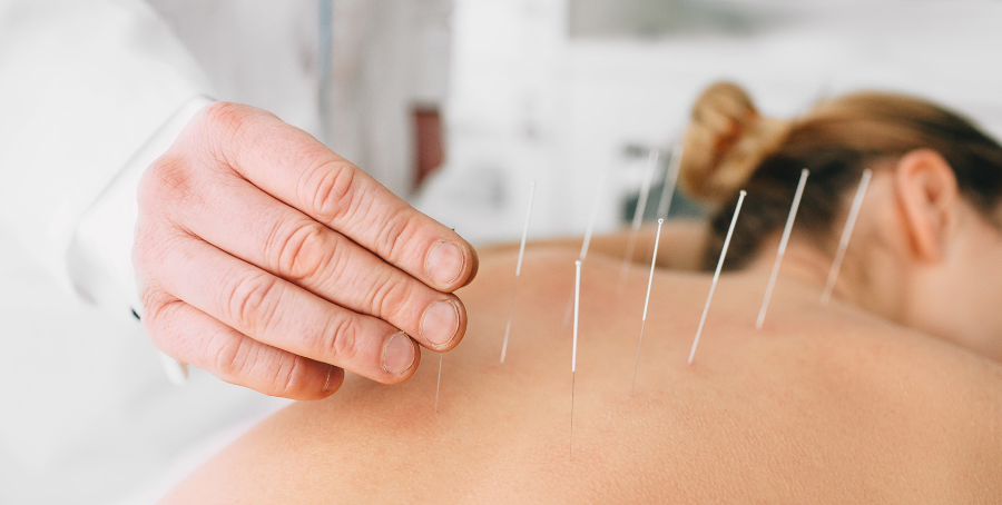 Acupuncture