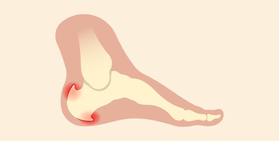 Plantar Fasciitis vs Heel Spur