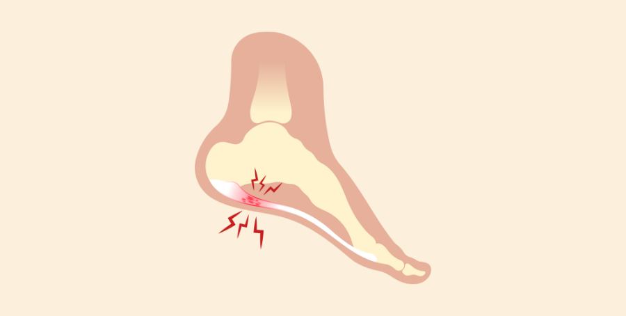 Plantar Fasciitis vs Heel Spur