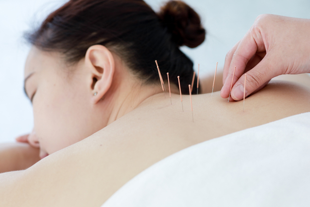 acupuncture