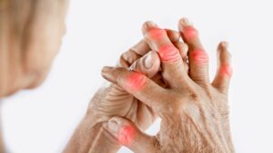 Finger Arthritis